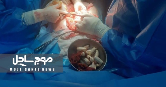 بیش از صد بسته جاسازی مواد مخدر از بدن یک جوان ۲۲ ساله خارج شد